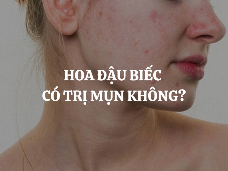 Hoa đậu biếc có trị mụn không? Cách sử dụng hoa đậu biếc trong hỗ trợ trị mụn